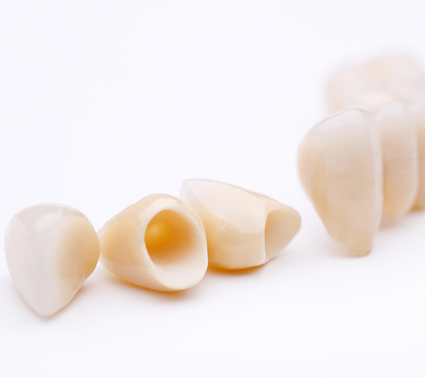 Los Gatos Dental Crowns and Dental Bridges