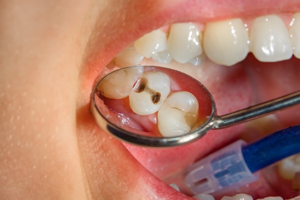 How Long Will My Dental Filling Last?