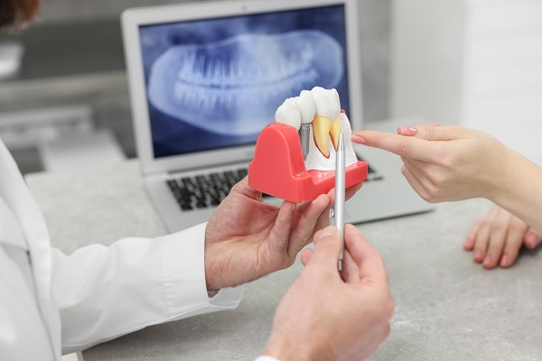 Who Is A Candidate For Dental Implants?