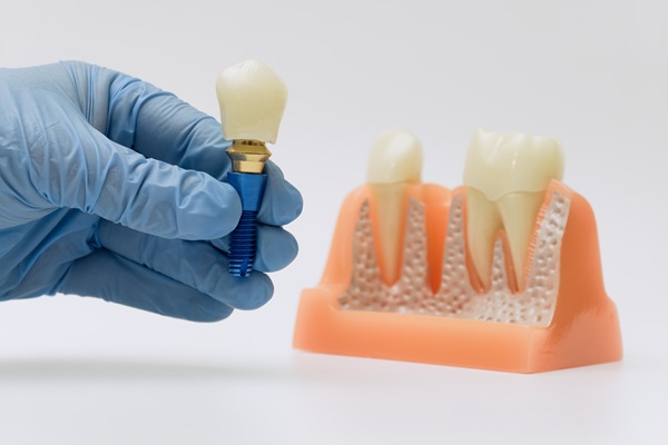 How Dental Implants Can Change Your Smile