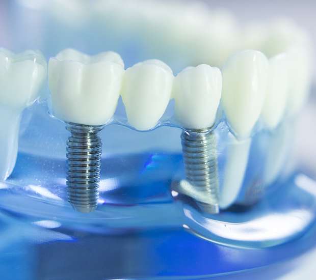 Los Gatos Dental Implants