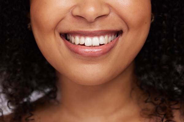 What To Expect During The Dental Veneers Process