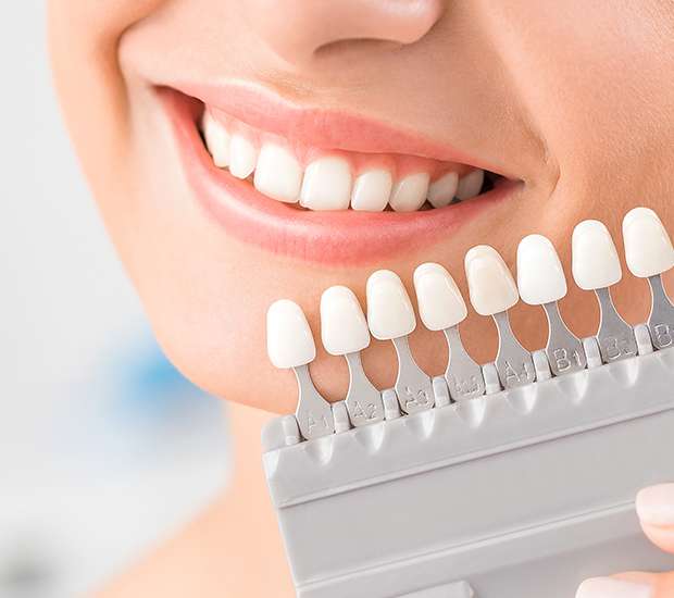 Los Gatos Dental Veneers and Dental Laminates