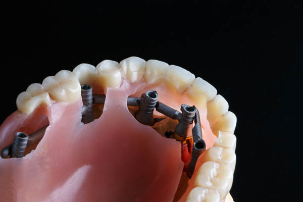 Implant Supported Dentures Los Gatos, CA