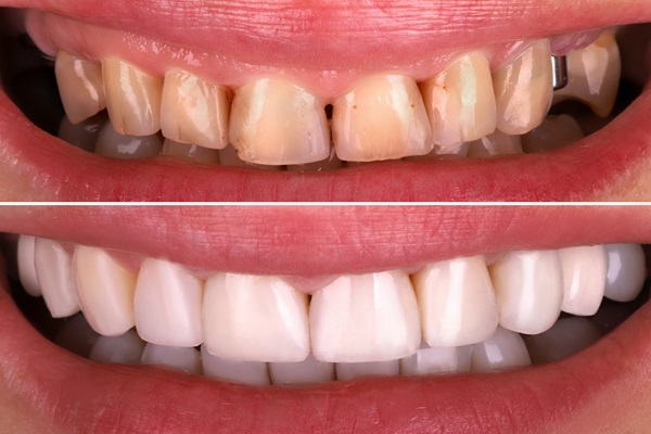 How Long Can A Smile Makeover Take?