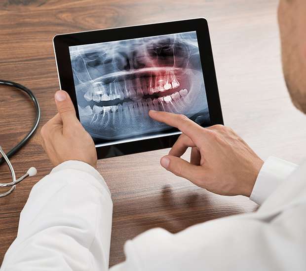 Los Gatos Types of Dental Root Fractures